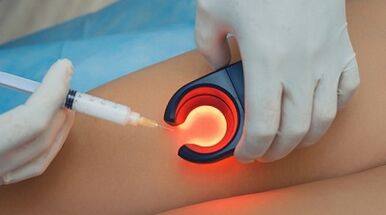Terapia de venosclerose para varizes