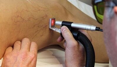 Tratamento a laser de varizes